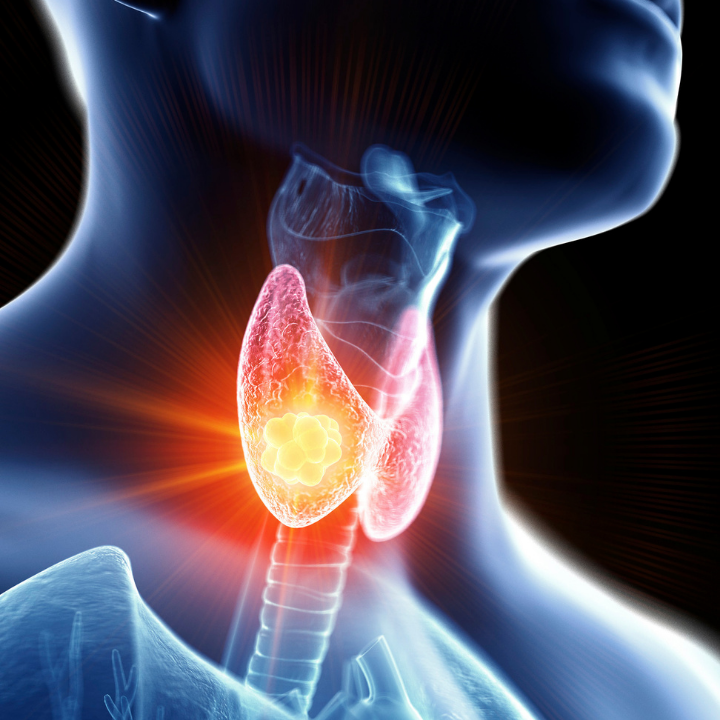 Thyroid cancer